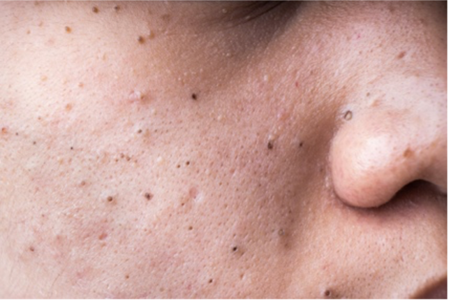 Closeup of face with blackheads