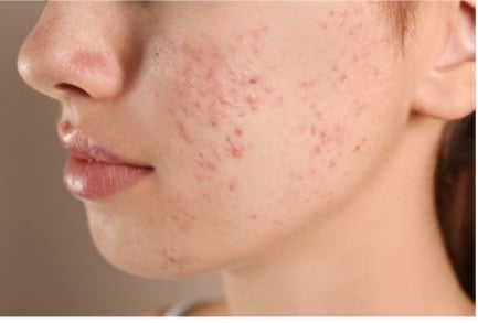 Closeup of pimples