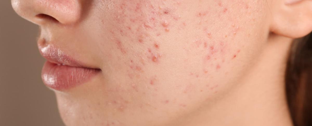 What does acne look like? | acne.com