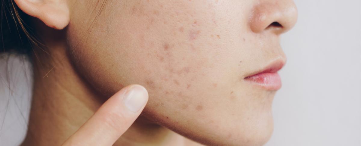 Person with acne scarring