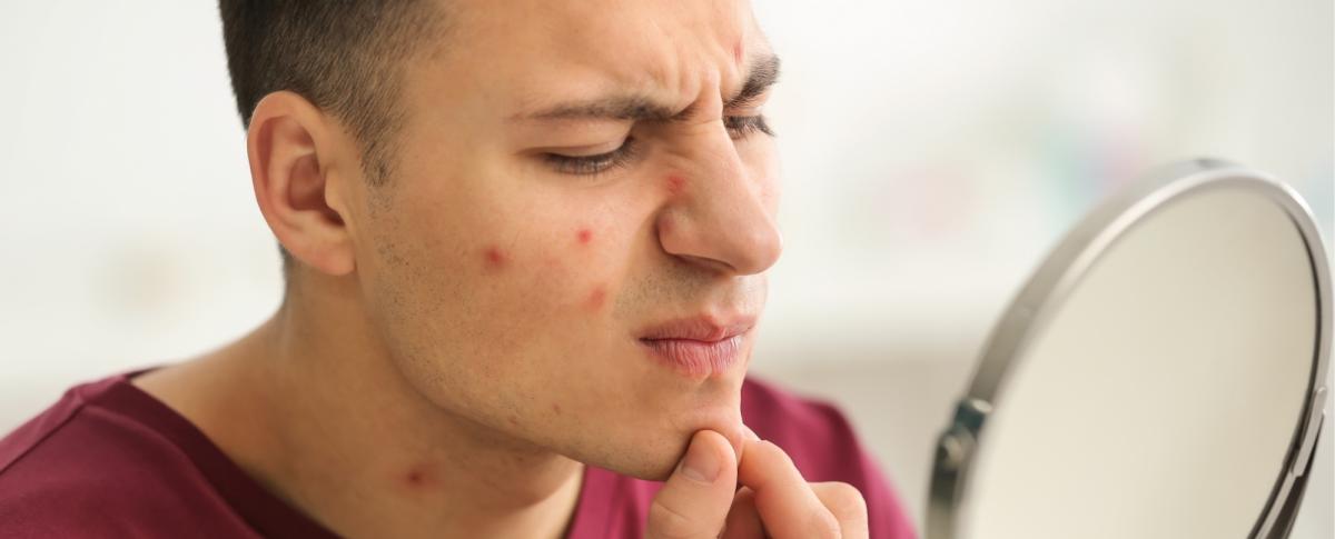 Person popping a pimple