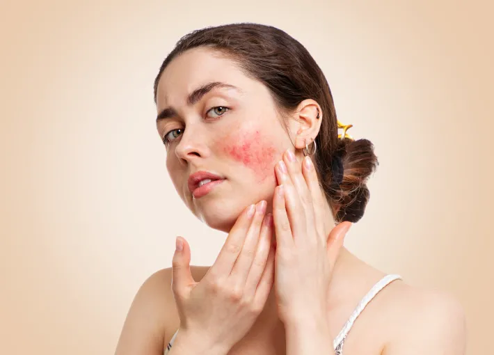 Acne rosacea