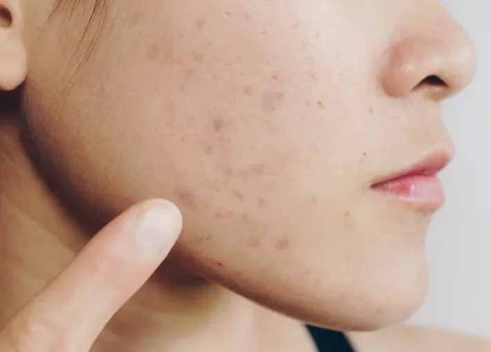 Person with acne scarring