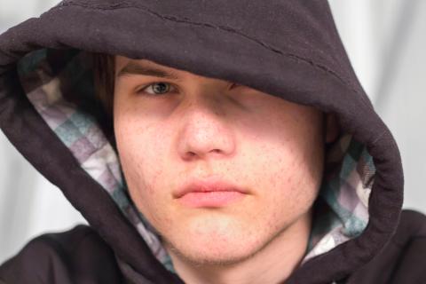 acne mental health