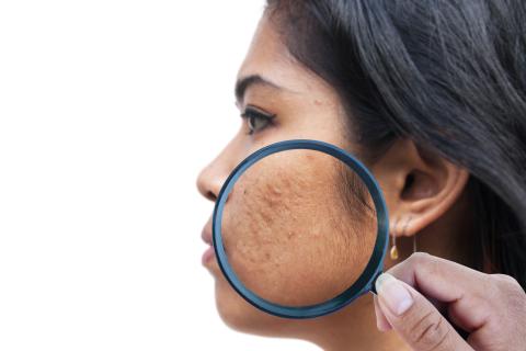 acne scaring