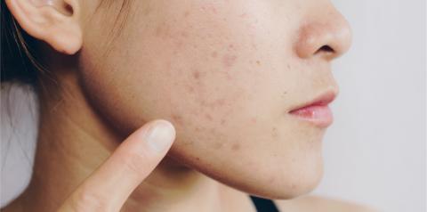 Person with acne scarring