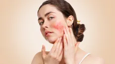 Acne rosacea