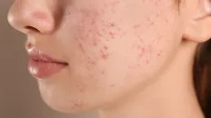 Face with pimples