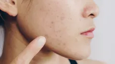 Person with acne scarring