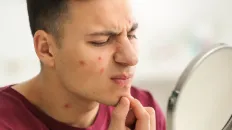Person popping a pimple